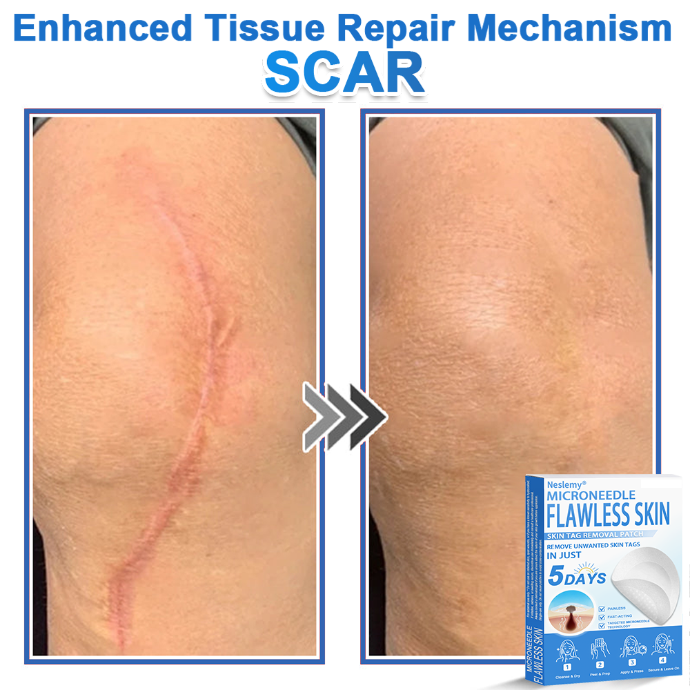 🔥Last Day 80% OFF 👨‍⚕️  Bellevery® 2-in-1 Microneedle & Hydrocolloid Patch | Raised Moles,Acne,  Flat Warts & Skin Tags Remover | Improves Wrinkles, Scars & Blemishes | Invisible Pimple Patches for Face & Body
