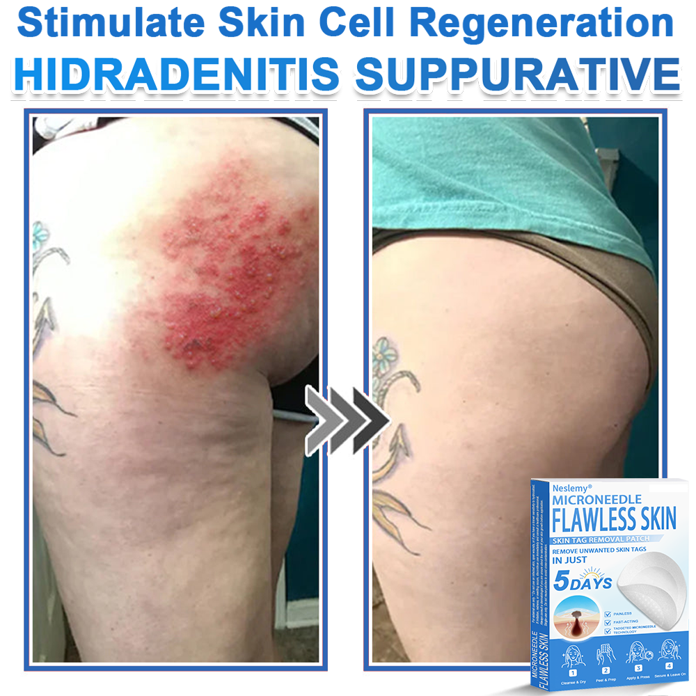 🔥Last Day 80% OFF 👨‍⚕️  Bellevery® 2-in-1 Microneedle & Hydrocolloid Patch | Raised Moles,Acne,  Flat Warts & Skin Tags Remover | Improves Wrinkles, Scars & Blemishes | Invisible Pimple Patches for Face & Body