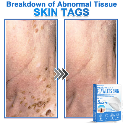 🔥Last Day 80% OFF 👨‍⚕️  Bellevery® 2-in-1 Microneedle & Hydrocolloid Patch | Raised Moles,Acne,  Flat Warts & Skin Tags Remover | Improves Wrinkles, Scars & Blemishes | Invisible Pimple Patches for Face & Body