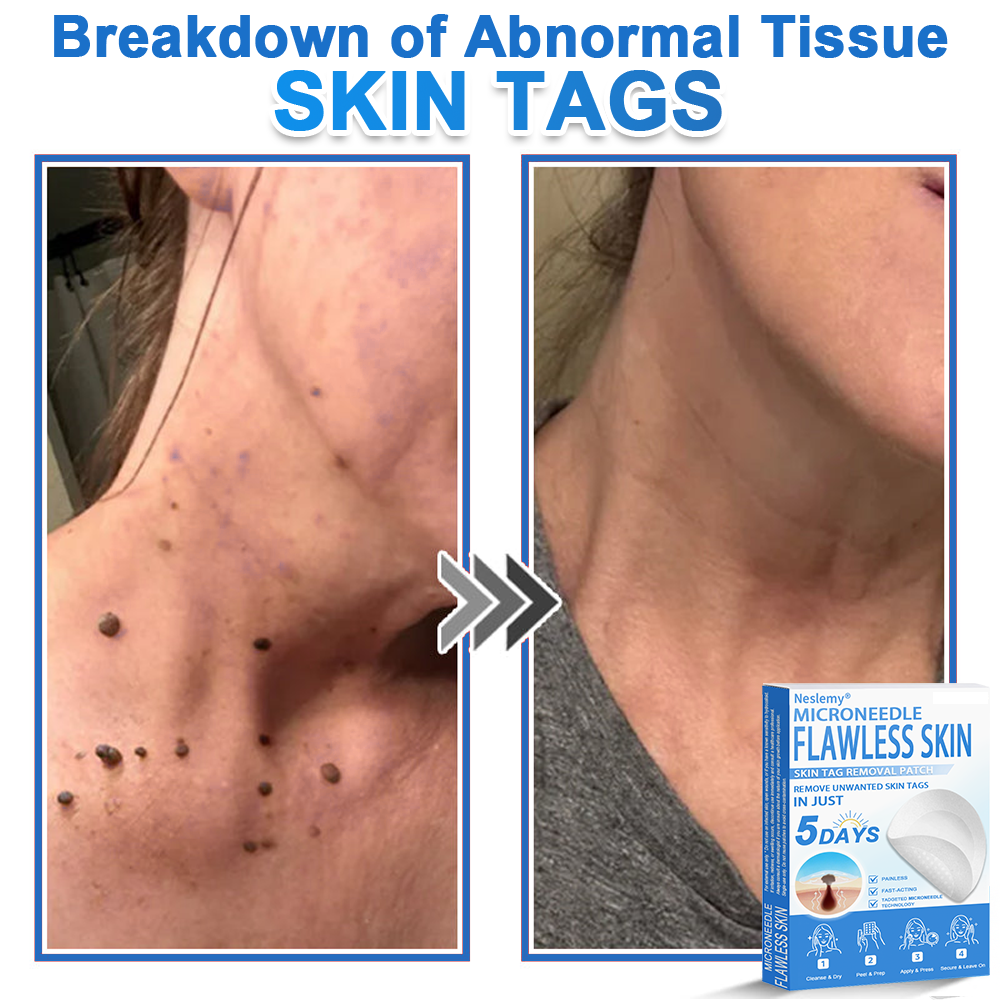 🔥Last Day 80% OFF 👨‍⚕️  Bellevery® 2-in-1 Microneedle & Hydrocolloid Patch | Raised Moles,Acne,  Flat Warts & Skin Tags Remover | Improves Wrinkles, Scars & Blemishes | Invisible Pimple Patches for Face & Body