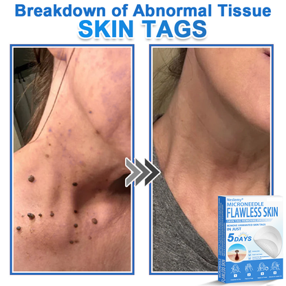 🔥Last Day 80% OFF 👨‍⚕️  Bellevery® 2-in-1 Microneedle & Hydrocolloid Patch | Raised Moles,Acne,  Flat Warts & Skin Tags Remover | Improves Wrinkles, Scars & Blemishes | Invisible Pimple Patches for Face & Body