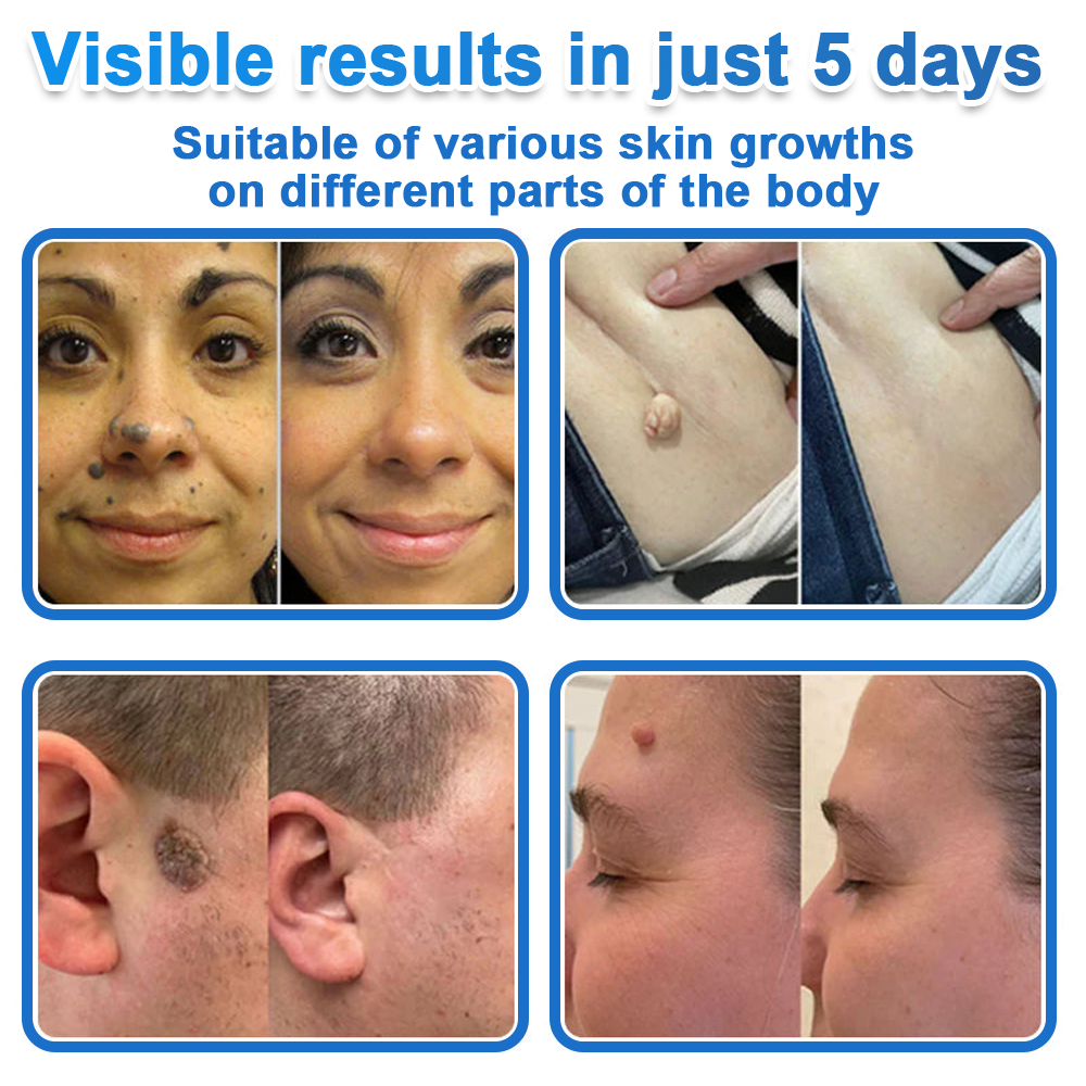 🔥Last Day 80% OFF 👨‍⚕️  Bellevery® 2-in-1 Microneedle & Hydrocolloid Patch | Raised Moles,Acne,  Flat Warts & Skin Tags Remover | Improves Wrinkles, Scars & Blemishes | Invisible Pimple Patches for Face & Body