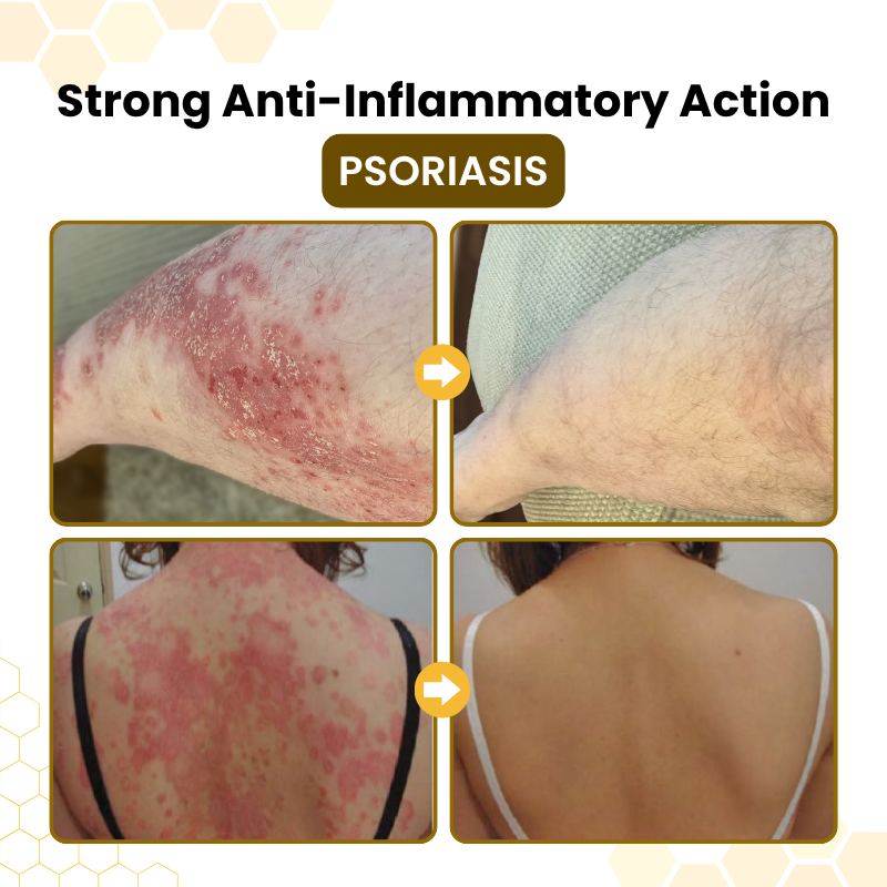 Bellevery® PsoriaSoothe Bee Venom Skin-Restoration Cream