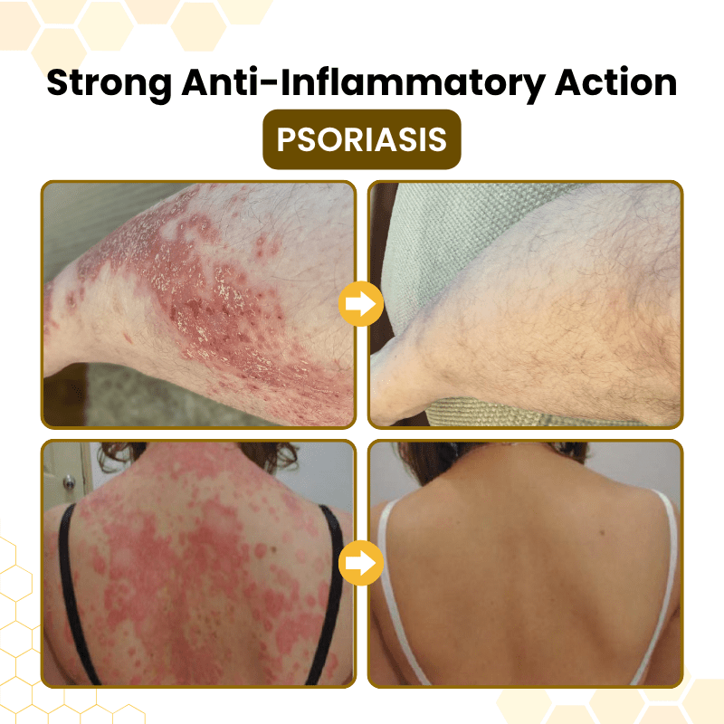 Bellevery® PsoriaSoothe Bee Venom Skin-Restoration Cream - Bellevery